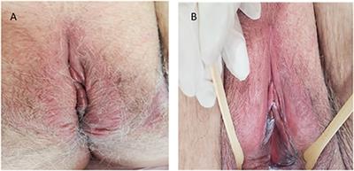 Genitourinary Syndrome of Menopause: Epidemiology, Physiopathology, Clinical Manifestation and Diagnostic